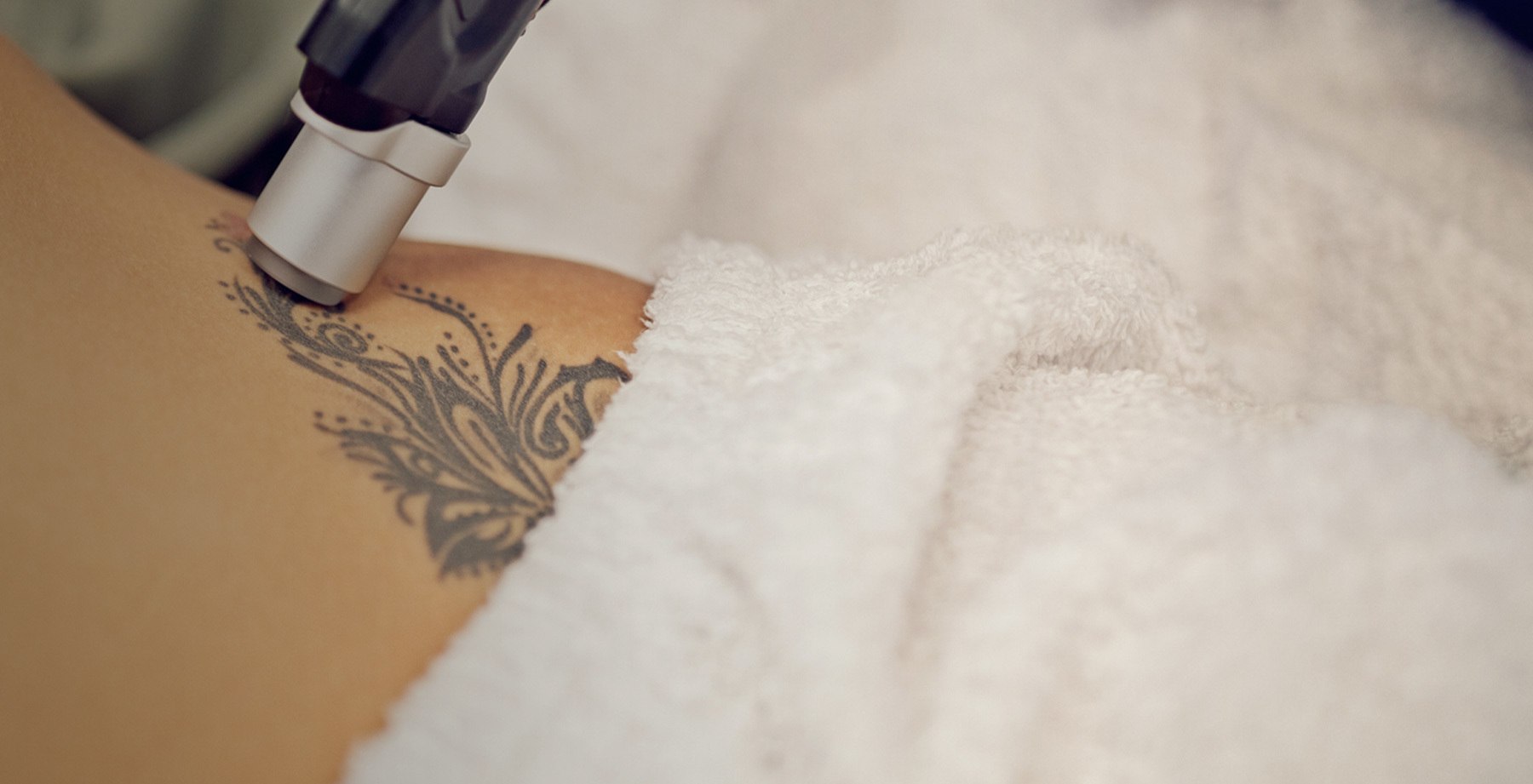 TattooRemoval_Hero